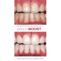 Ultradent Opalescence BOOST PF 40% Ofis Tipi Beyazlatma 4'lü Şırınga Ultradent Opalescence BOOST PF 40% Ofis Tipi Beyazlatma 4'lü Şırınga