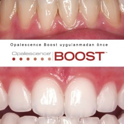 Ultradent Opalescence BOOST PF 40% Ofis Tipi Beyazlatma 4'lü Şırınga Ultradent Opalescence BOOST PF 40% Ofis Tipi Beyazlatma 4'lü Şırınga