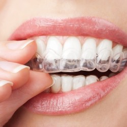 FGM Whiteness Perfect %16 Ev Tipi Beyazlatma Tekli Şırınga FGM Whiteness Perfect %16 Ev Tipi Beyazlatma Tekli Şırınga