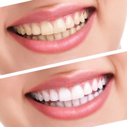Ultradent Opalescence PF 16% Ev Tipi Beyazlatma 2'li Şırınga Ultradent Opalescence PF 16% Ev Tipi Beyazlatma 2'li Şırınga